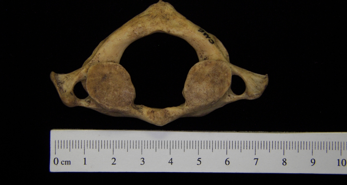 Human C1 (1st cervical vertebra), inferior view