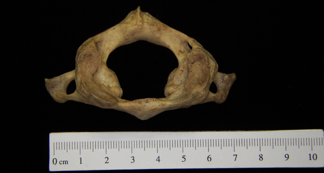 Human C1 (1st cervical vertebra), superior view