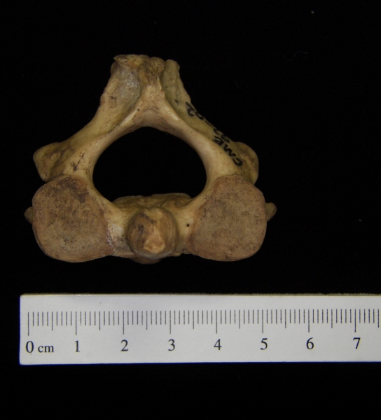 Human C2 (2nd cervical vertebra), superior view