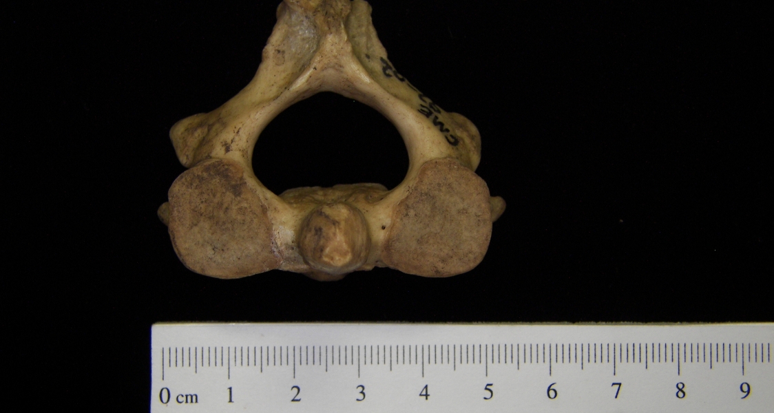 Human C2 (2nd cervical vertebra), superior view