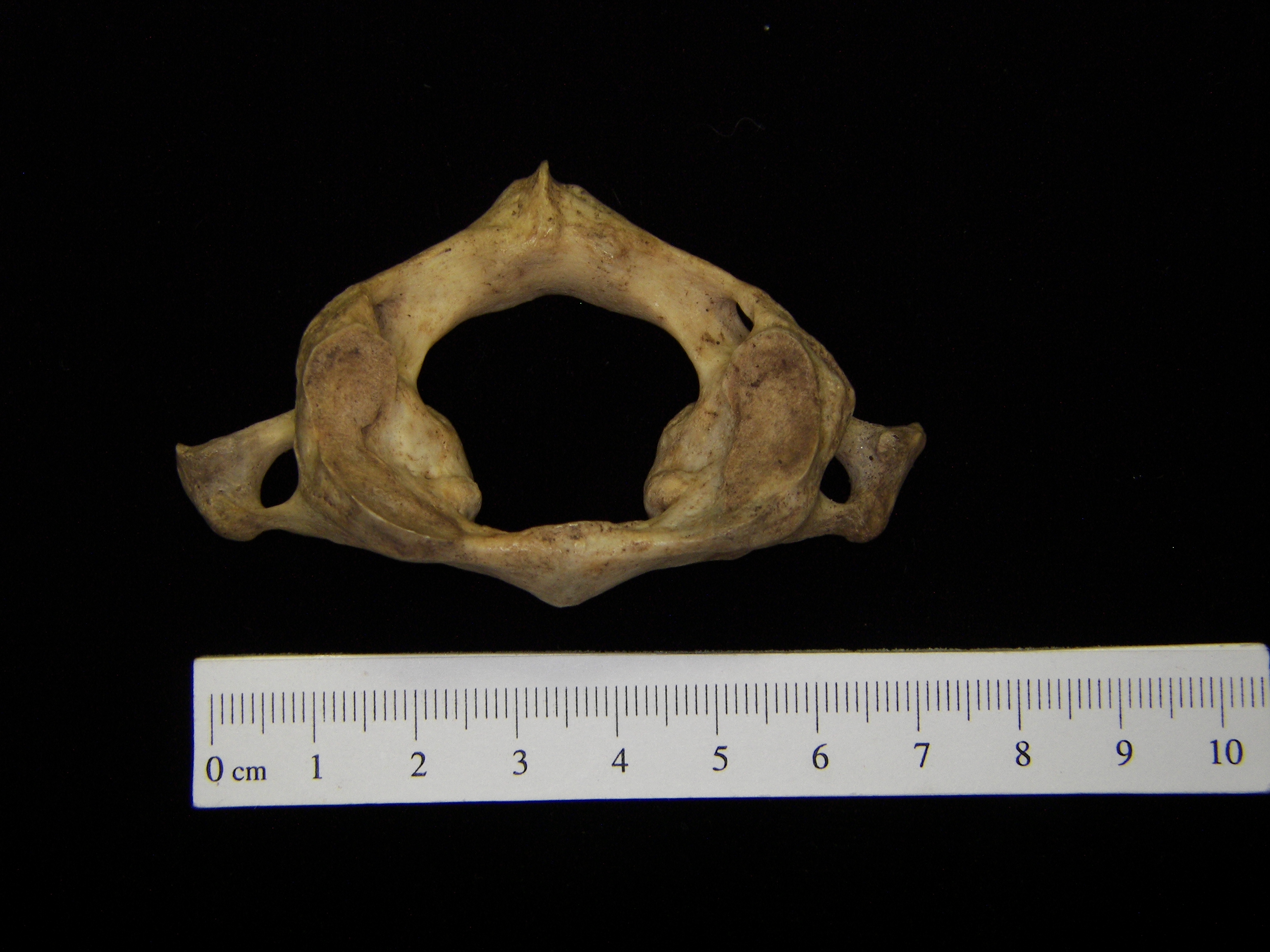 Human C1 (1st cervical vertebra), superior view