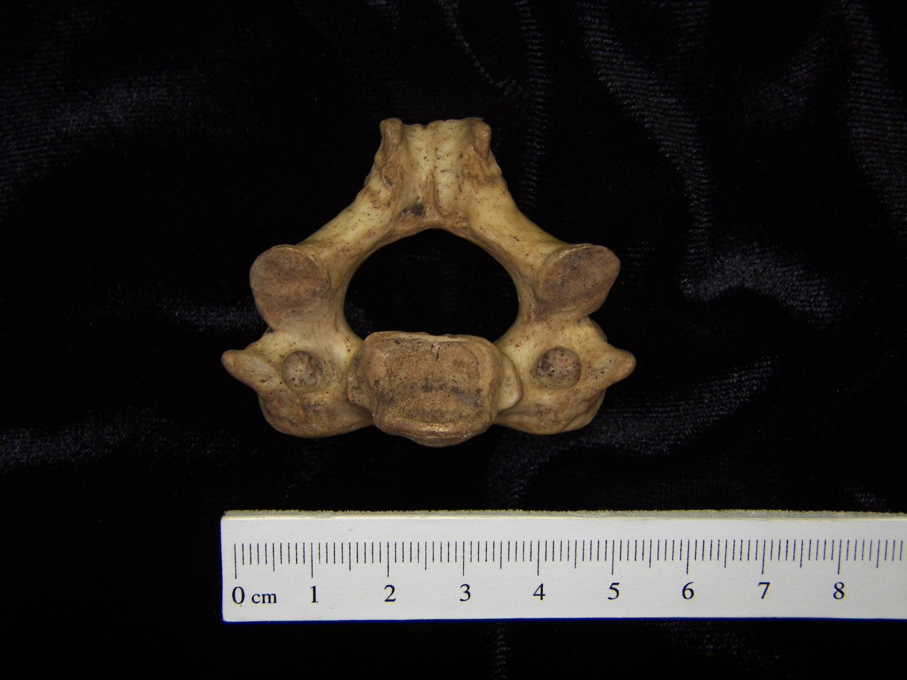 Human C2 (2nd cervical vertebra), inferior view