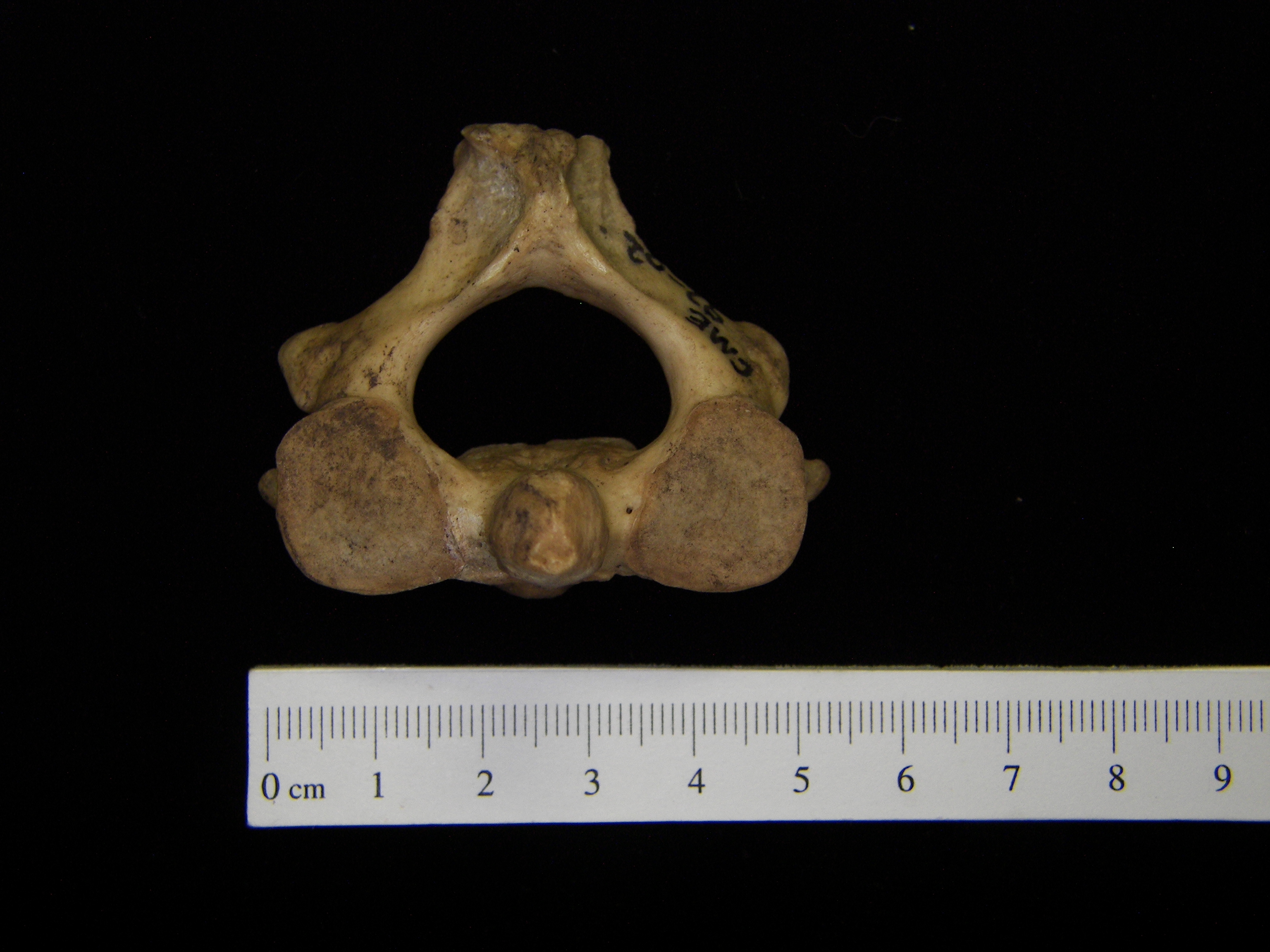 Human C2 (2nd cervical vertebra), superior view